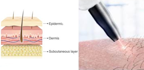 毛發(fā)移植種植培訓(xùn)班 毛發(fā)移植種植培訓(xùn)班