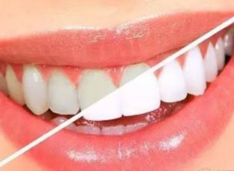 牙齿美容 牙齿美容