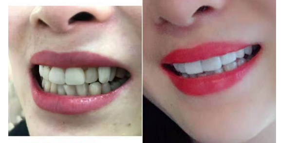 美牙前后 美牙前后