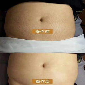 妊娠纹课程 妊娠纹课程