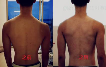 佛山脊柱侧弯培训班 佛山脊柱侧弯培训班