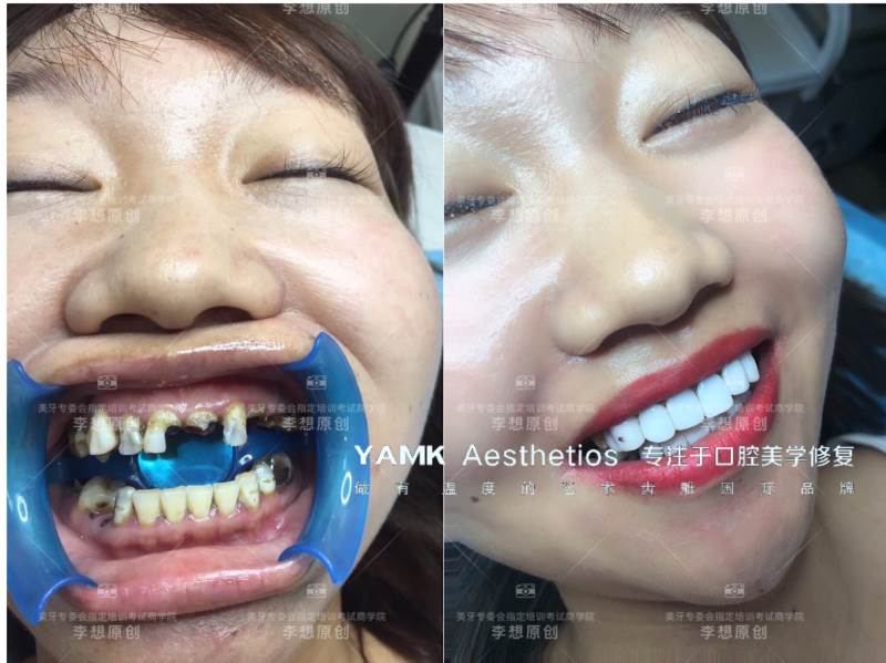 美牙效果1