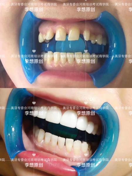 美牙效果5