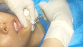 玻尿酸填充 玻尿酸填充