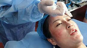 PRP自体血清 PRP自体血清