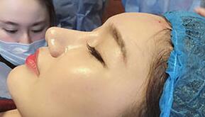 MTS微针离子导入 MTS微针离子导入