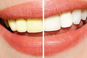 传统美牙与浮雕美牙 传统美牙与浮雕美牙