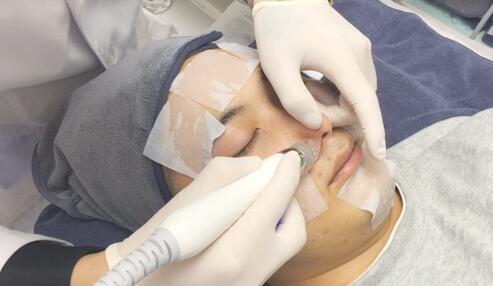 化学焕肤 化学焕肤