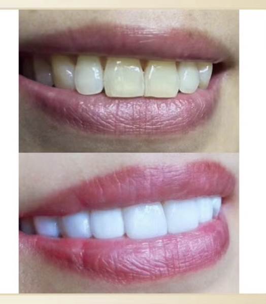 美牙效果展示四