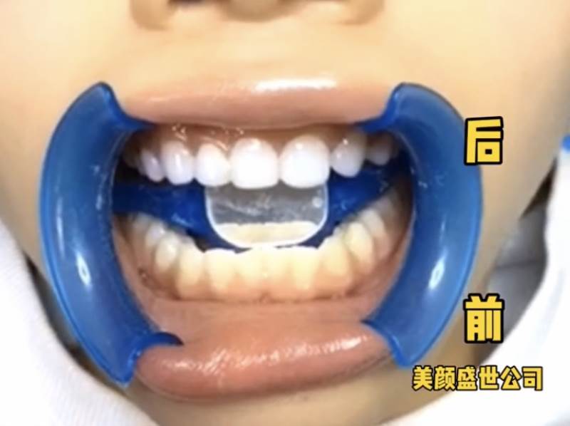 美牙效果展示七