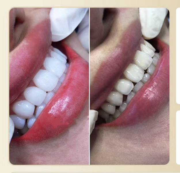 美牙效果对比四