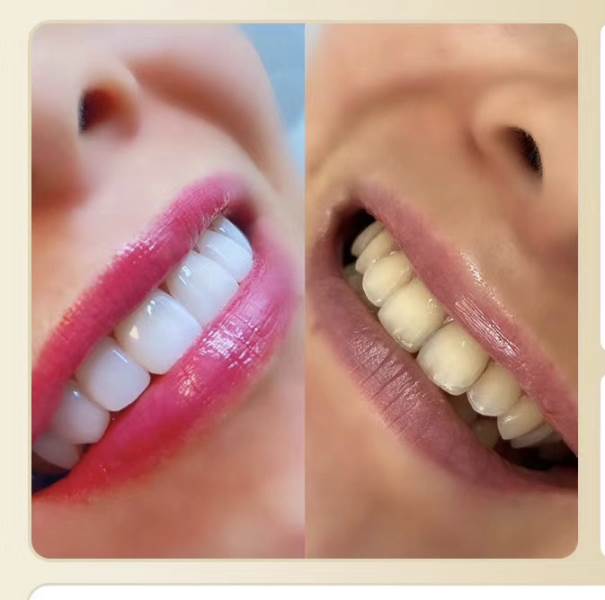 美牙效果对比六