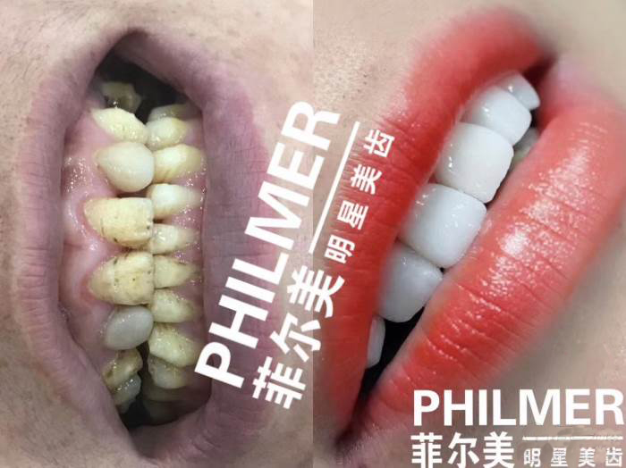 美牙前后对比 美牙前后对比