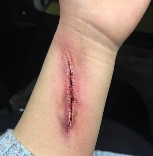 伤效仿真——手臂划伤 伤效仿真——手臂划伤