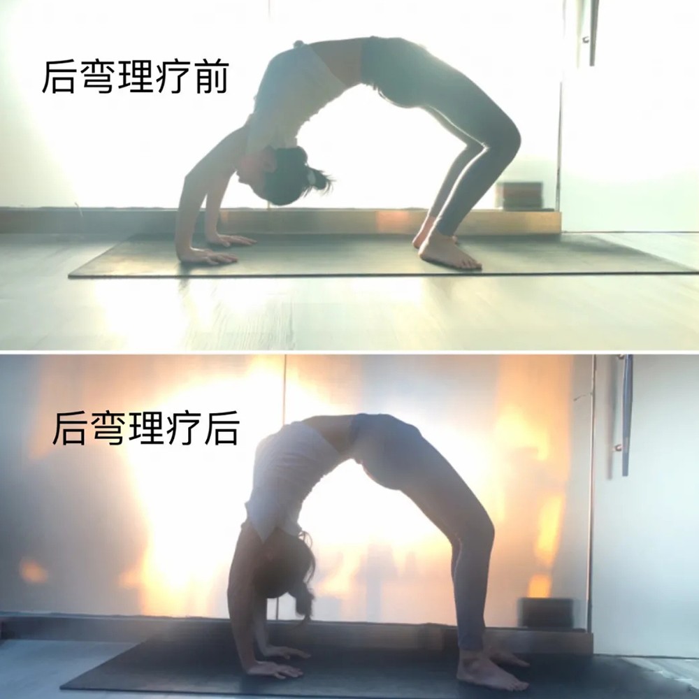 后弯理疗前后对比