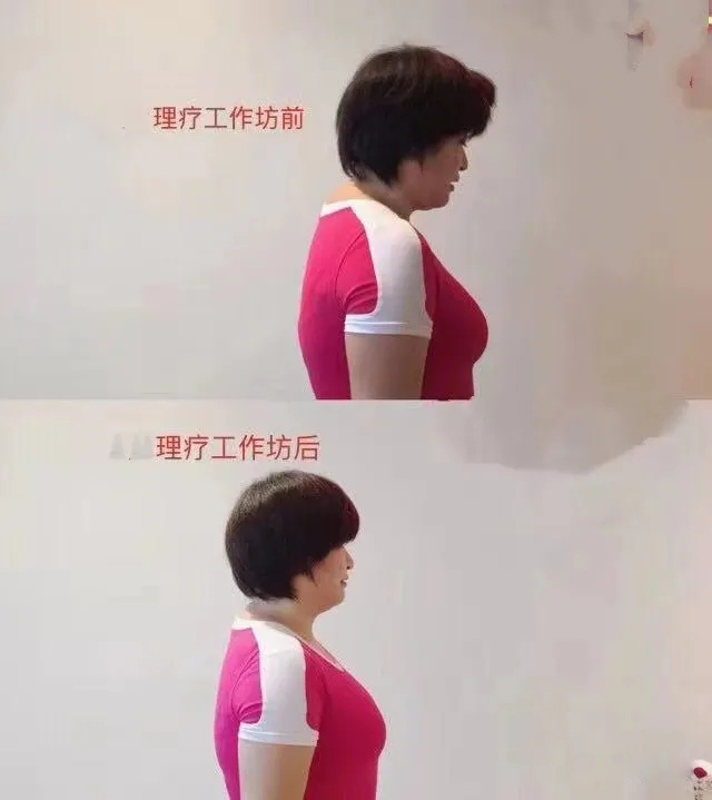 颈椎理疗前后对比