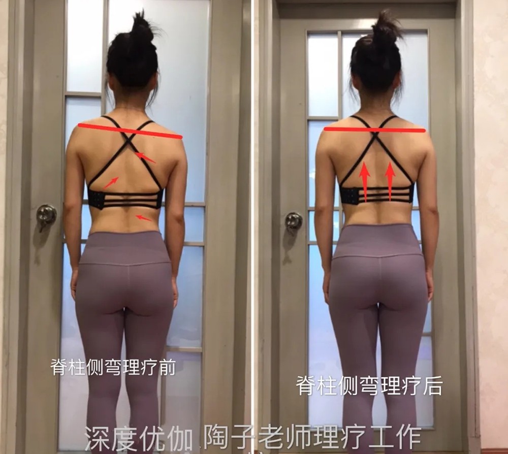 脊柱侧弯理疗前后对比