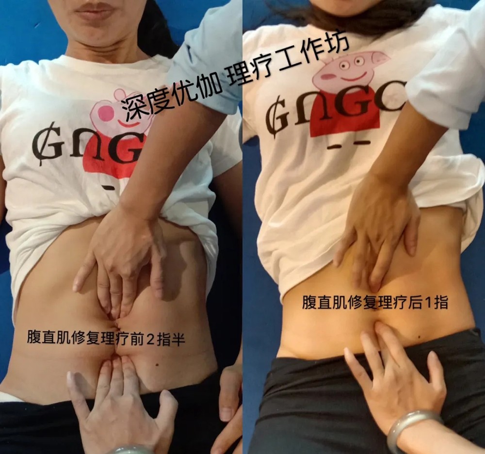 腹直肌修复理疗前后对比