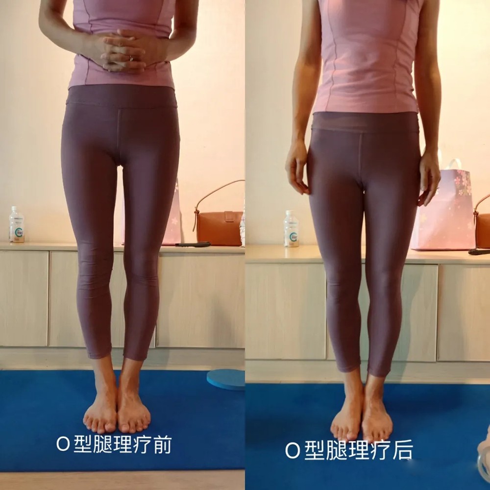 O型腿理疗前后对比
