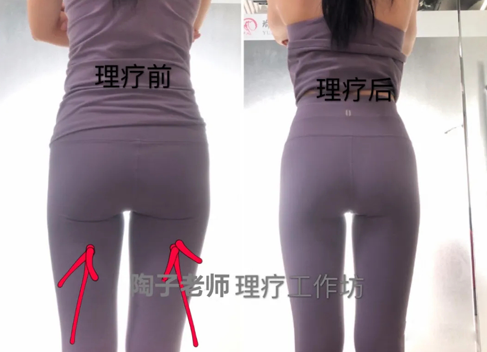 臀部理疗前后对比