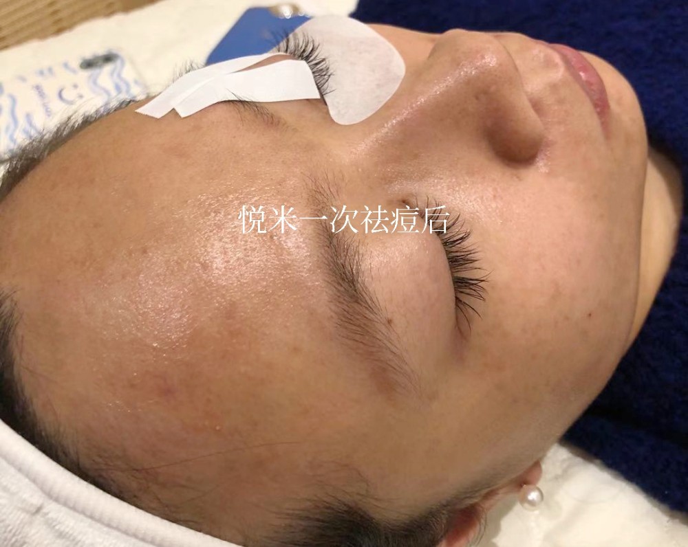 一次祛痘后 一次祛痘后
