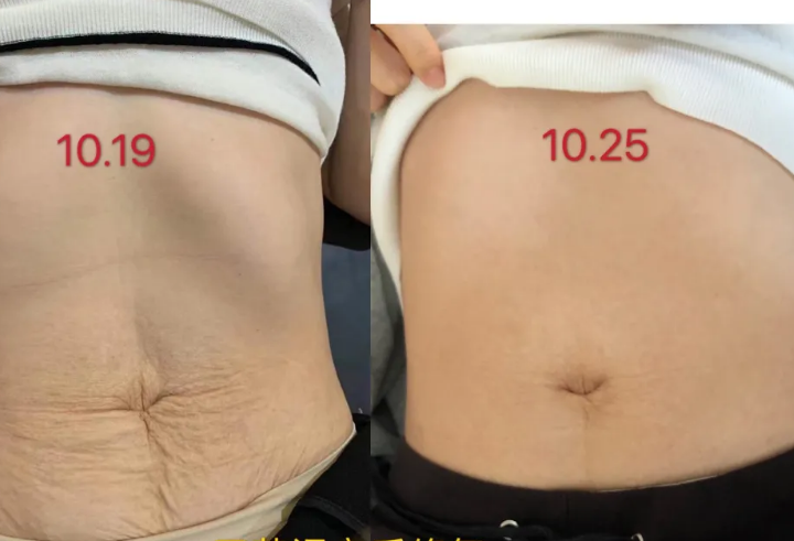 三节课产后修复对比 三节课产后修复对比