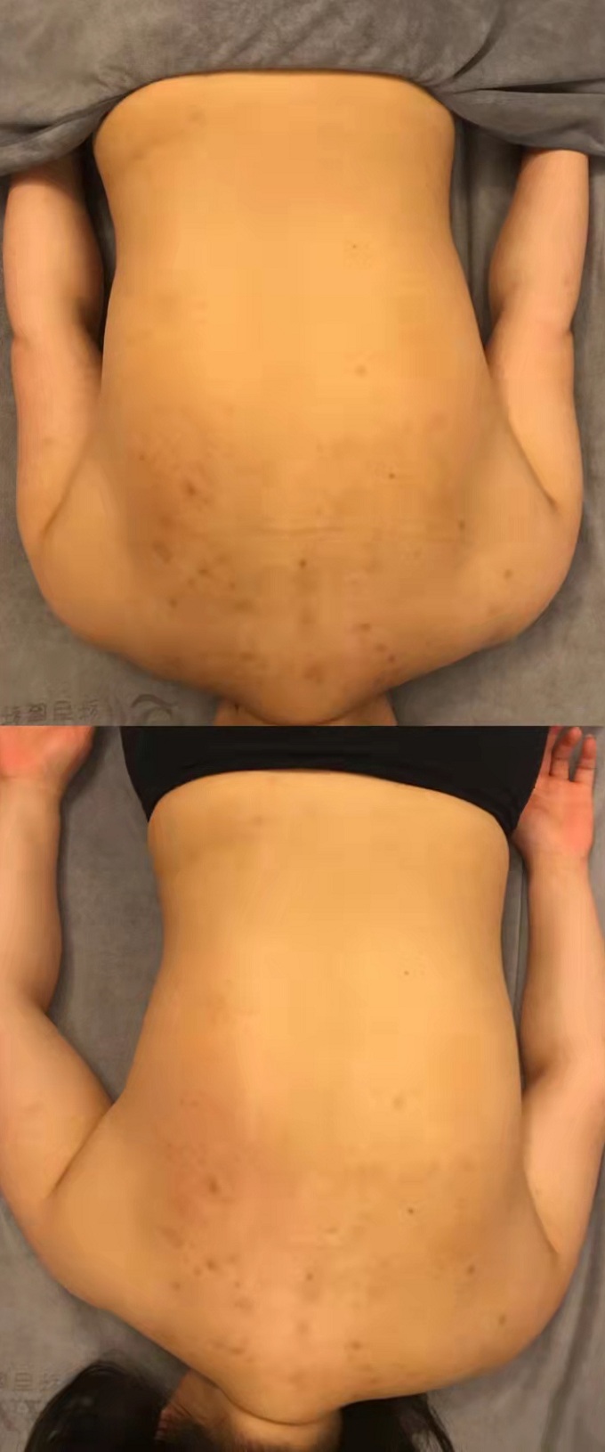 骨骼筋膜一次效果图片