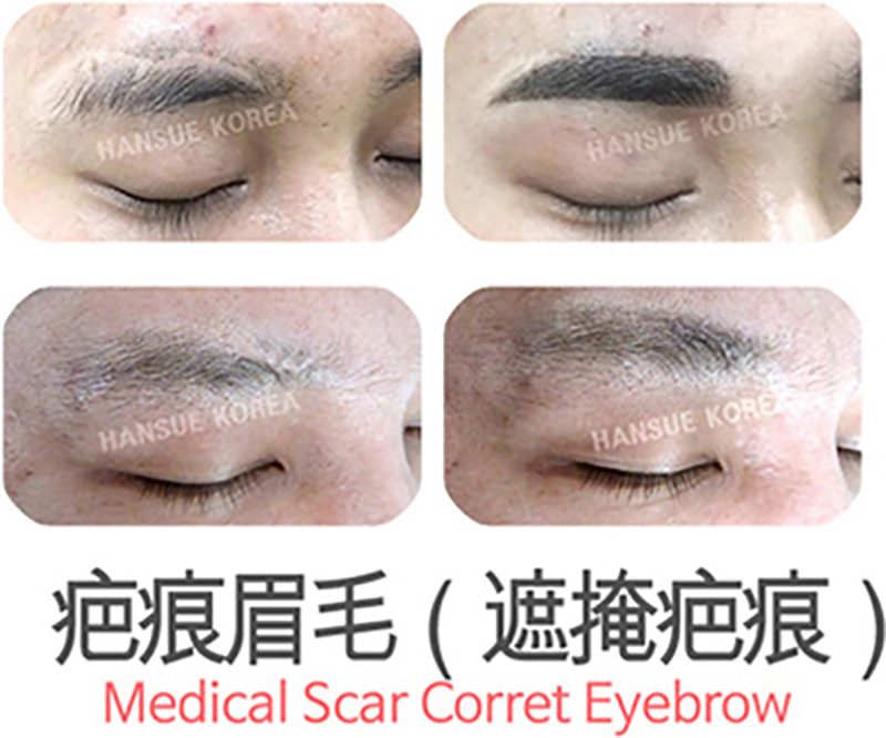 遮蓋疤痕 遮蓋疤痕