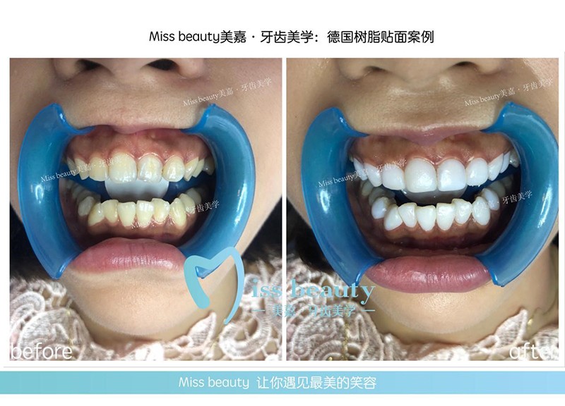 德国树脂贴面美牙