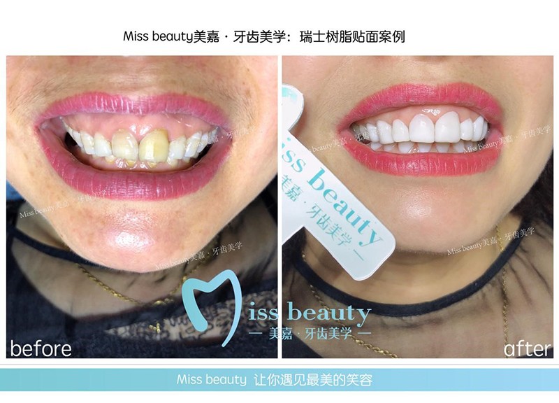 瑞士树脂贴面美牙