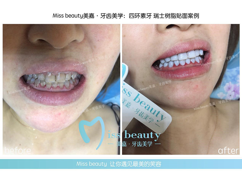 瑞士冰瓷树脂贴面美牙