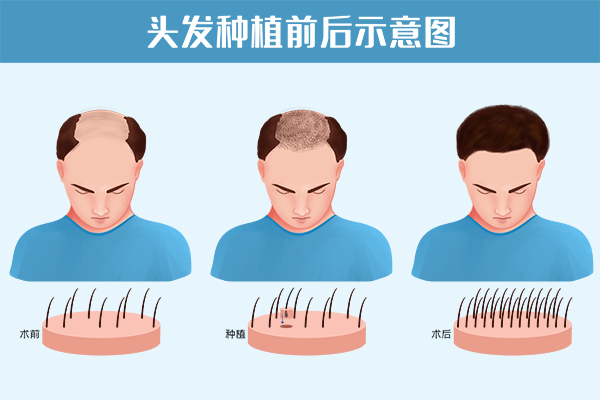 头发种植前后对比图
